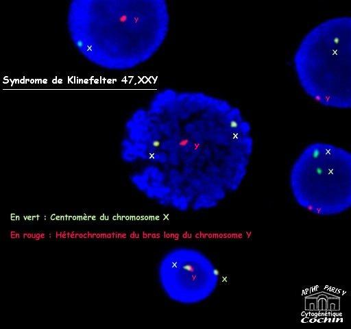 47,xxy chromosomes